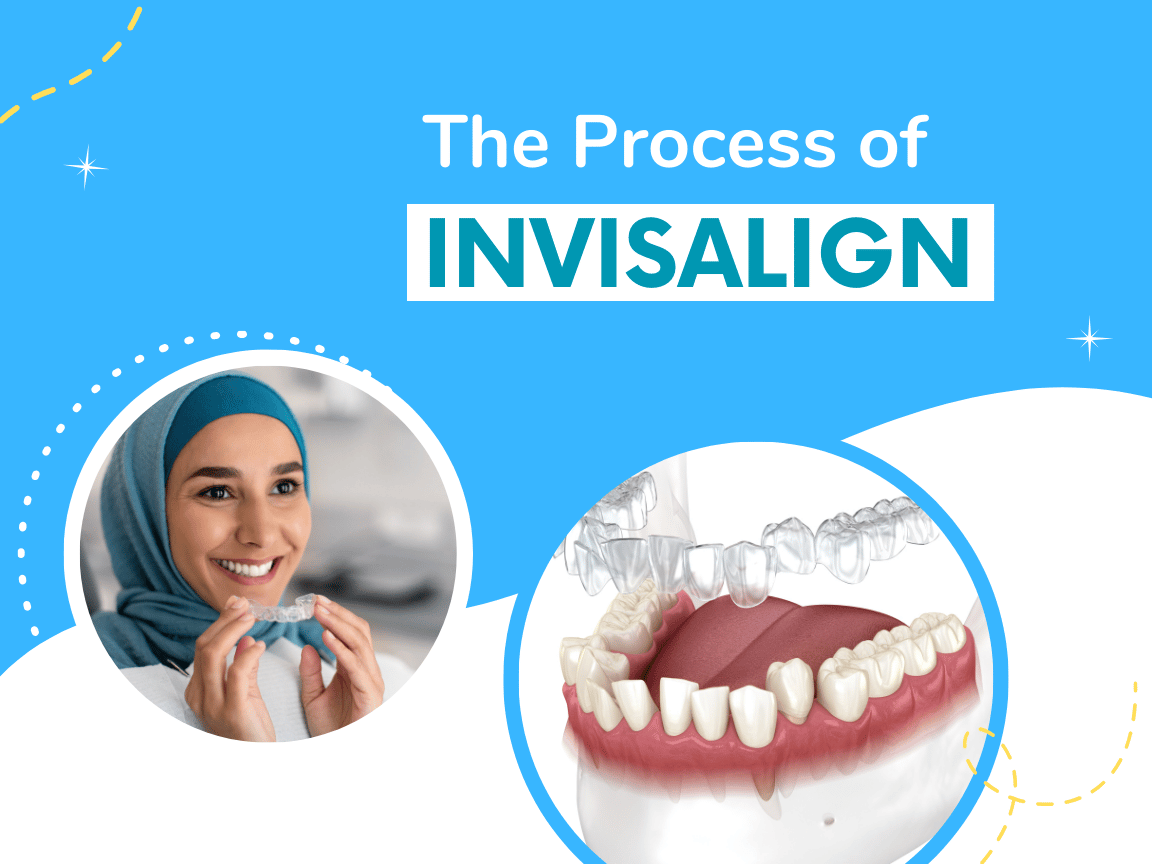 Read more about the article The Process of Invisalign Treatment