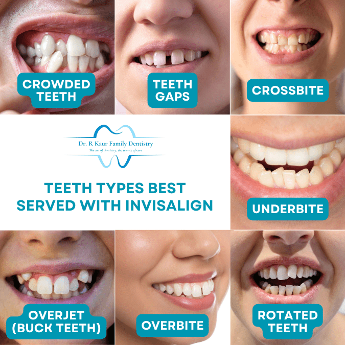 Which Tooth types are best served with Invisalign_Invisalign Aligners Solutions at Cambridge Ontario_R Kaur Family Dentistry_3